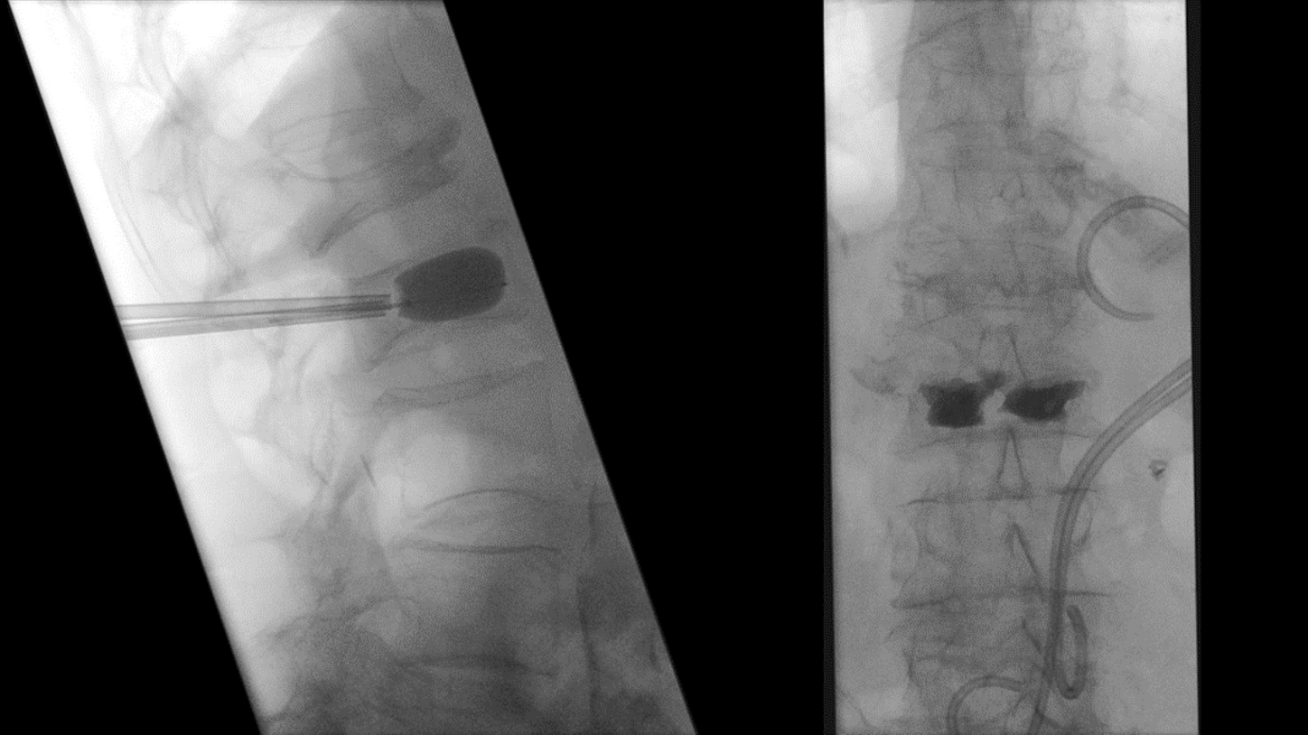 Osteoporotic vertebral compression fracture of L2 (AO Spine: OF 4) treated with bilateral transpedicular balloon kyphoplasty.    